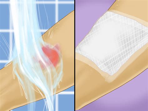 To help heal and soothe stinging skin, it is important to begin treating sunburn as soon as you notice it. How to Treat a Chemical Burn: 14 Steps (with Pictures)