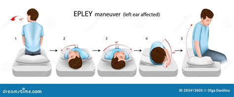 Epley Maneuver Left Ear Affected Vector Illustration Stock Vector