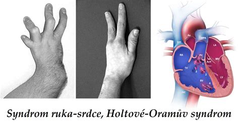 Syndrom Ruka Srdce Holtové Oramův Syndrom Holt Oram Syndrome