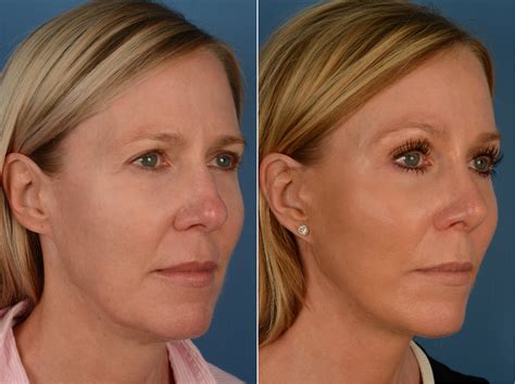 The Uplift™ Lower Face And Neck Lift Rhinoplasty Photos Naples Fl