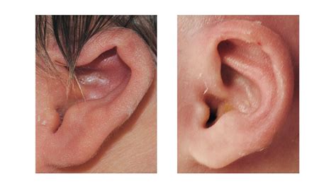 Constrictedlopcup Ears Childrens Hospital Of Philadelphia