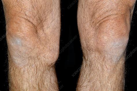 Torn Knee Ligament Stock Image C0263372 Science Photo Library