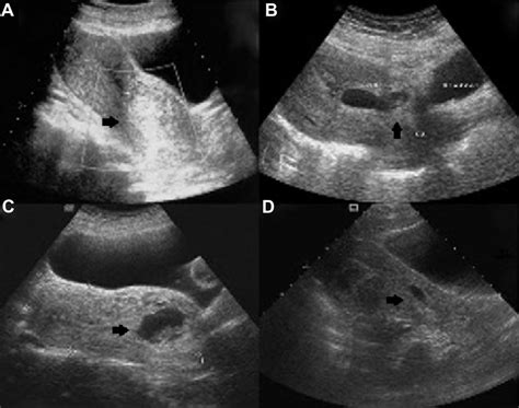 Transabdominal Ultrasound Images Showing A An 8 Week 1 Day Cervical