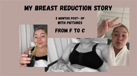 My Breast Reduction Story With Pictures Tips Youtube