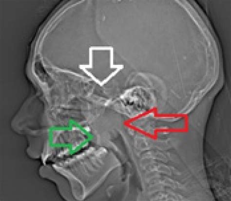 Plain X Ray Of The Head And Neck Region For Nasopharynx There Is Soft