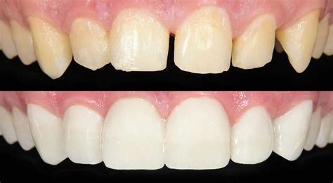 How To Fix Gap In Teeth Dental Bonding Teeth Bonding 101 Everything