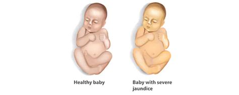 How To Care For Your Baby With Jaundice Sidra Medicine