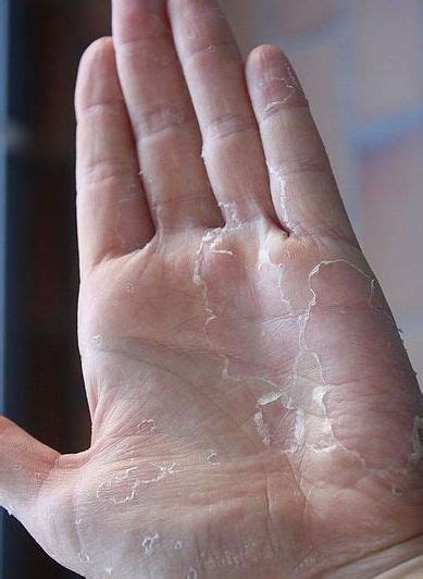 10 Things Your Hands Can Tell About Your Health—do Your Hands Ever Feel