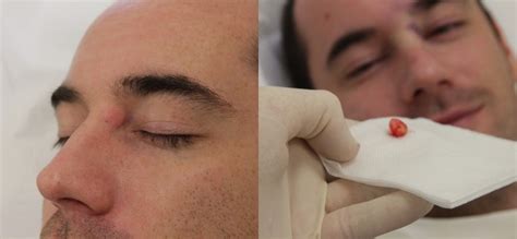 Cyst Removal Prices Costs Skin Surgery Laser Clinic