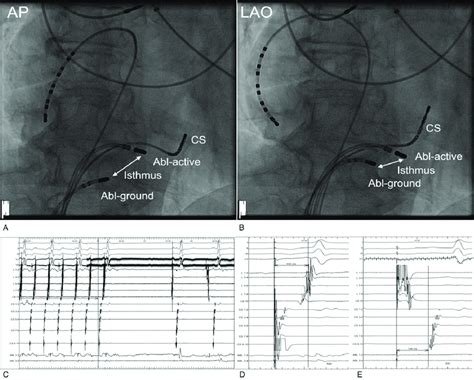 Bipolar Ablation Of The Cavo Tricuspid Isthmus Dependent Atrial Flutter