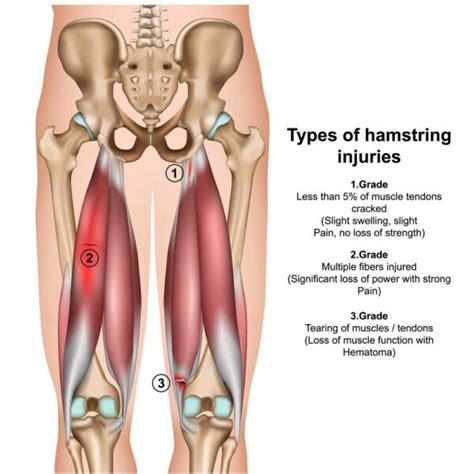 Hamstring Injuries Hip Pain Orthopedic Hip Specialist Manhattan My