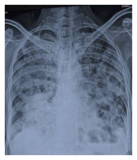 X Ray Chest Pa View Shows Bilateral Diffuse Consolidation And