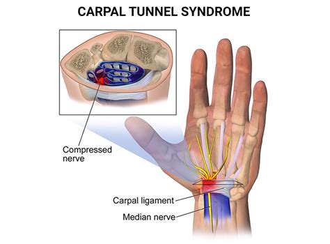 Carpal Tunnel Syndrome Treatment Nyc Hand Pain In New York