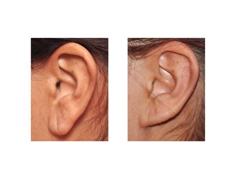 Otoplasty In The Long Ear Macrotia Explore Plastic Surgery