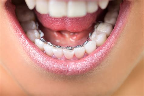 How Much Are Braces Prices For All Brace Types In The Uk