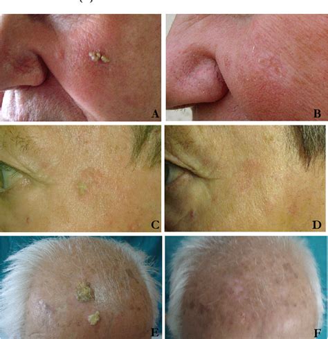 List 93 Pictures Pictures Of Actinic Keratosis And Seborrheic
