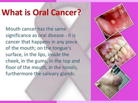 Oral Cancer Treatment In Delhi