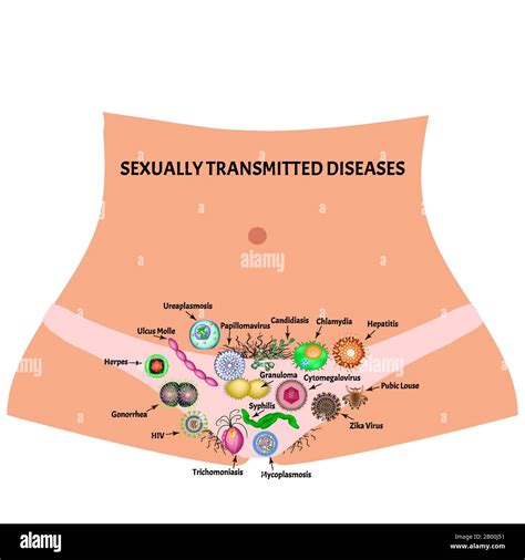 Infecciones Virales Y Bacterianas Enfermedades De Transmisión Sexual