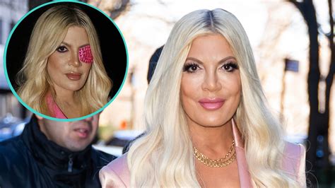Watch Access Hollywood Highlight Tori Spelling Reveals She Has An Eye Ulcer After Leaving In