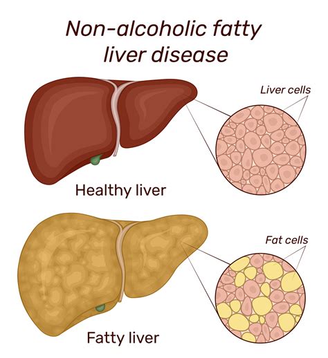 Non Alcoholic Fatty Liver Know The Symptoms Of This Reversible Disease Free Hot Nude Porn Pic