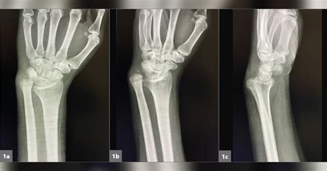 A 39 Year Old Man With A Chronic Monteggia Fracture Dislocation