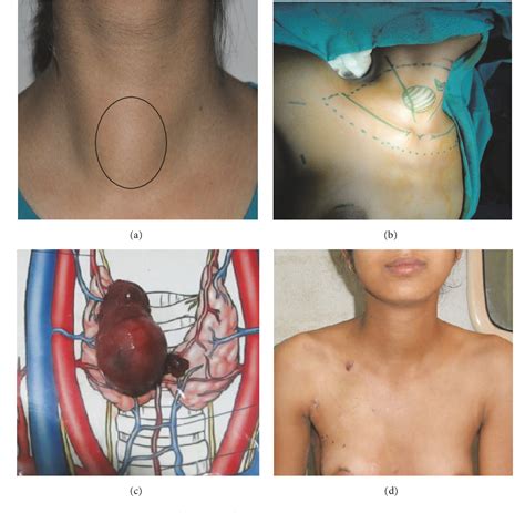 Pdf Feasibility Of Endoscopic Thyroidectomy Via Axilla And Breast