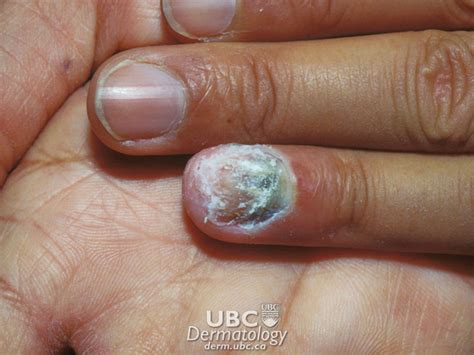 Cspa Overview What Are Fungal Infections