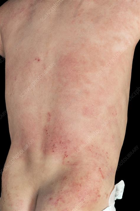 Atopic Eczema On A Babys Back Stock Image C0389473 Science