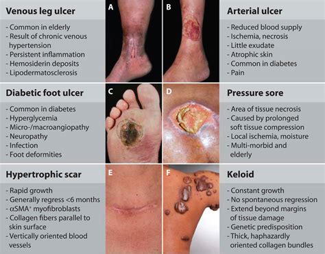 Venous and arterial ulcers are two different entities with regard to causatives, clinical features, and location. Wound repair and regeneration: Mechanisms, signaling, and ...