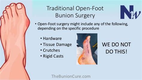 Bunion Surgery Recovery Time