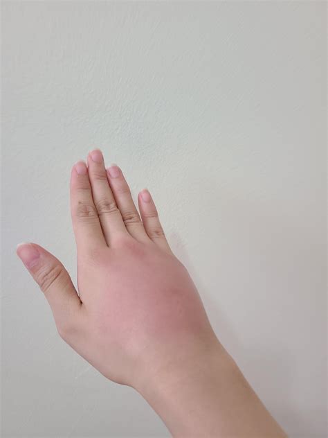Bug Bite Swelling Hand