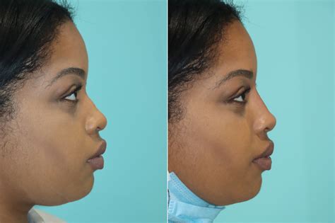 Non Surgical Rhinoplasty Photos Chevy Chase Md Patient 19683