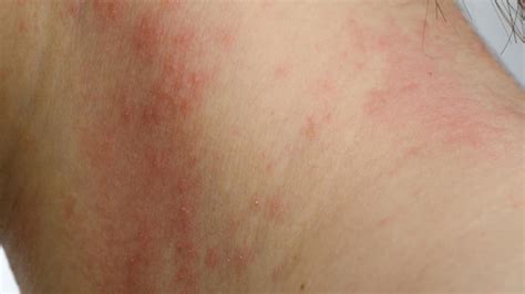 Contact Dermatitis Causes Symptoms And Treatment