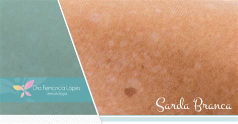 A psoríase é uma doença inflamatória da pele que causa vermelhidão e irritação na pele. Dra. Fernanda Lopes Dermatologia - Blog - Sardas Brancas