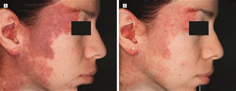 description and analysis of treatments for port wine stain birthmarks jama facial plastic