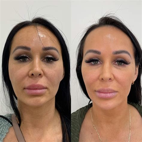 sculptra before and after images medspa in newport beach ca