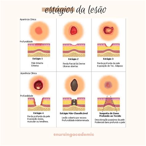 Lesão Por Pressão Estágio