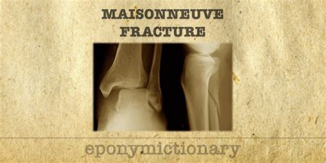 Maisonneuve Fracture • Litfl • Medical Eponym Library
