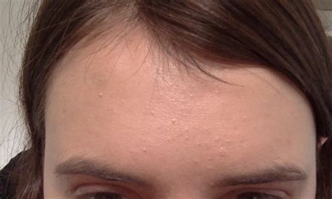 Member Pictures Forehead Bumps Photo On 07 11 2014 At 1259 Image 1