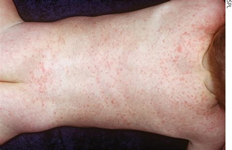 Diagnosis And Management Of Common Viral Skin Infections Thandi