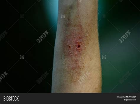 Wound Hurt Blood Drops Image And Photo Free Trial Bigstock