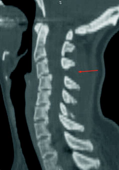 Imaging After Trauma To The Neck The Bmj