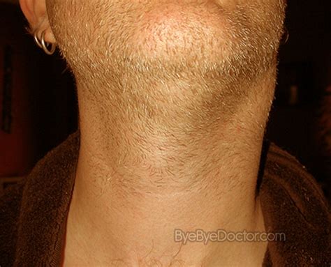 Swollen Glands In Neck Causes Treatment Pictures