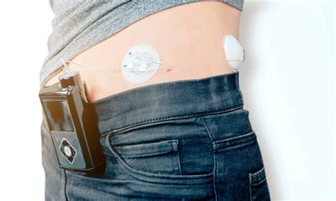 Bionic Pancreas Bests Standard Care For Improving Type 1 Diabetes