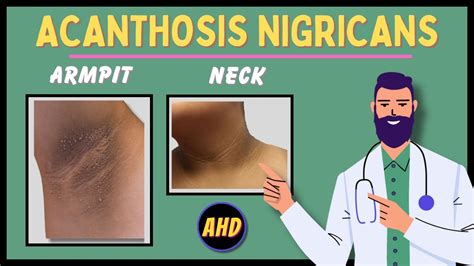 Acanthosis Nigricans Armpit Treatment