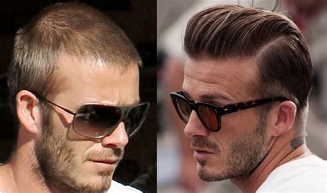 David Beckham Hair Transplant Hold The Hairline