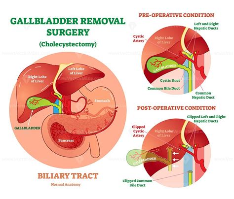 Cholecystectomy Gallbladder Removal Surgery Anatomical Vector Illustration Diagram VectorMine