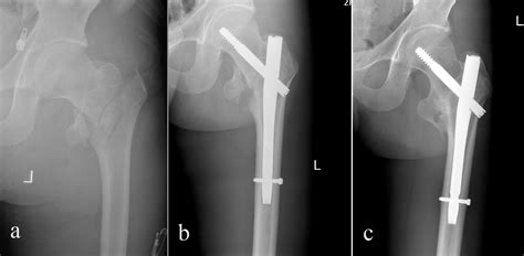 Comparative Study Of Trochanteric Fracture Treated With The Proximal