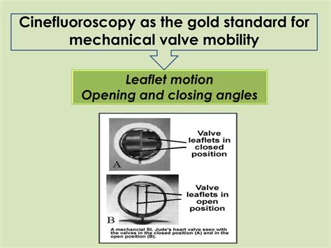 Role Of Cinefluoroscopy In Prosthetic Valve Disease