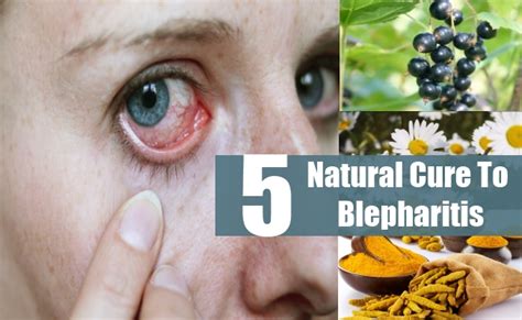 Top 5 Natural Cures For Blepharitis How To Cure Blepharitis Naturally